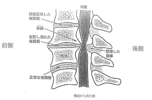 ブログ再開　　頚椎症の手術をしました